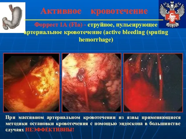 Активное кровотечение Форрест 1А (FIa) - струйное, пульсирующее артериальное кровотечение (active bleeding