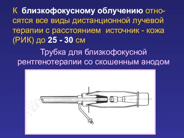 К близкофокусному облучению отно-сятся все виды дистанционной лучевой терапии с расстоянием источник