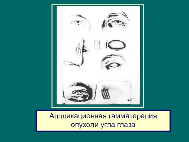 Аппликационная гамматерапия опухоли угла глаза