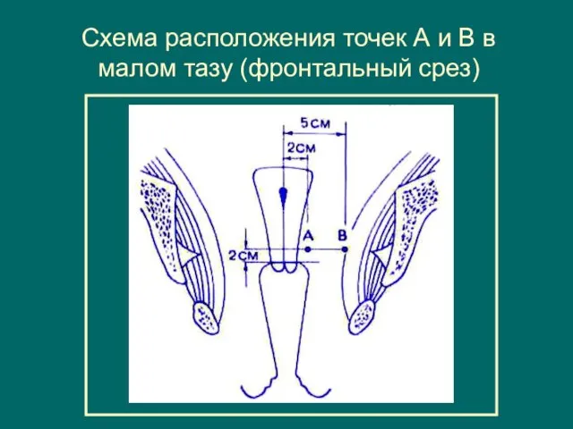 Схема расположения точек А и В в малом тазу (фронтальный срез)