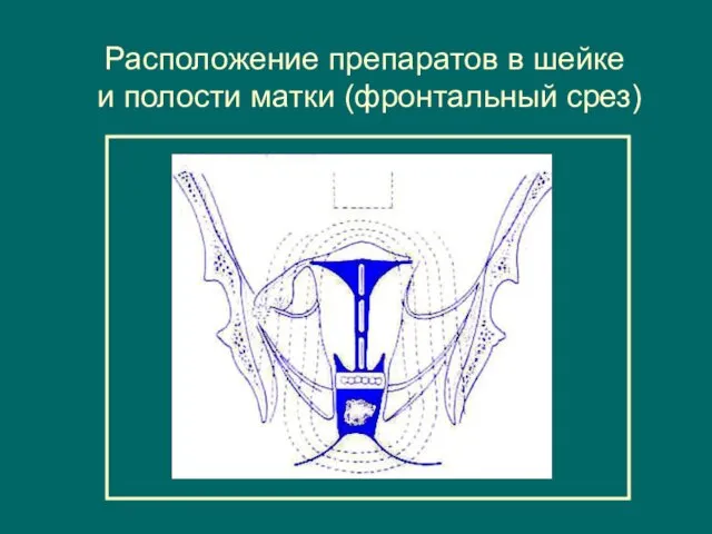 Расположение препаратов в шейке и полости матки (фронтальный срез)