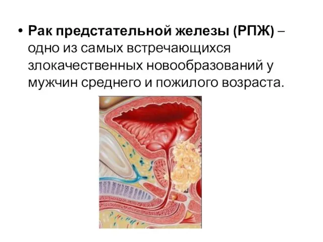 Рак предстательной железы (РПЖ) – одно из самых встречающихся злокачественных новообразований у