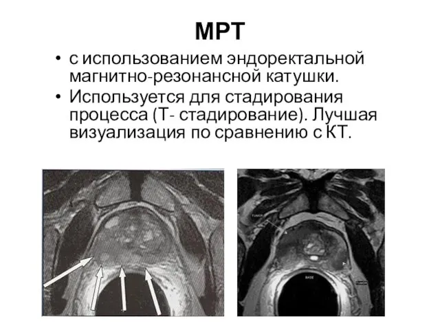 МРТ с использованием эндоректальной магнитно-резонансной катушки. Используется для стадирования процесса (Т- стадирование).