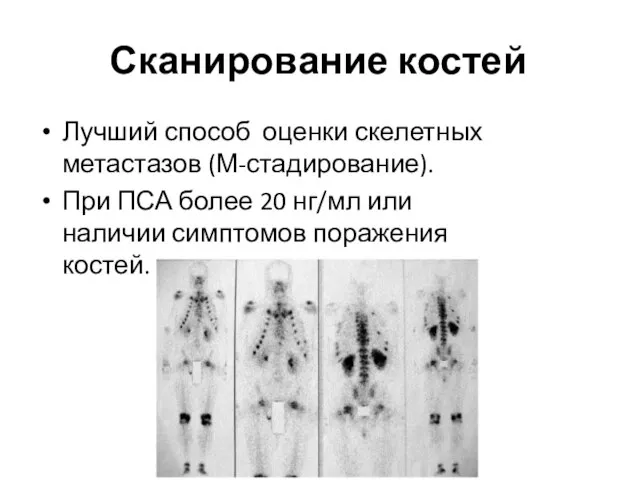 Сканирование костей Лучший способ оценки скелетных метастазов (М-стадирование). При ПСА более 20