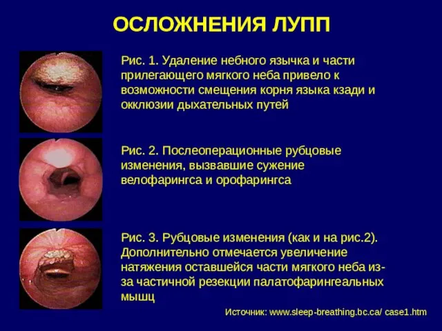 ОСЛОЖНЕНИЯ ЛУПП Рис. 1. Удаление небного язычка и части прилегающего мягкого неба