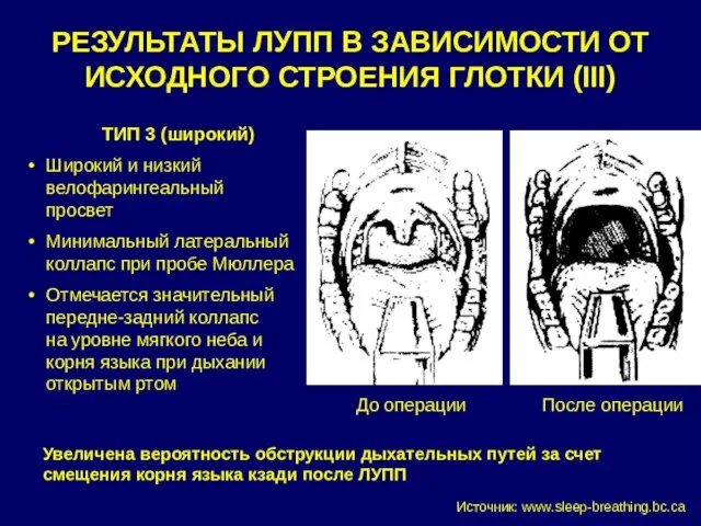 РЕЗУЛЬТАТЫ ЛУПП В ЗАВИСИМОСТИ ОТ ИСХОДНОГО СТРОЕНИЯ ГЛОТКИ (III) ТИП 3 (широкий)