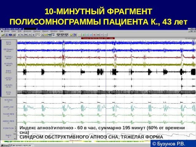 10-МИНУТНЫЙ ФРАГМЕНТ ПОЛИСОМНОГРАММЫ ПАЦИЕНТА К., 43 лет Индекс апноэ/гипопноэ - 60 в