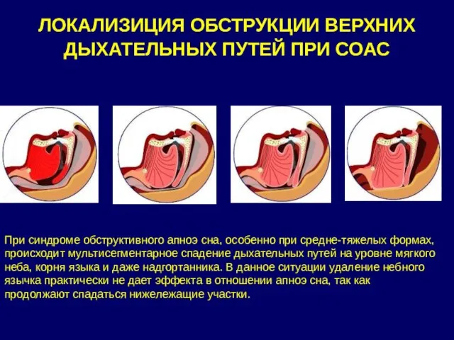 ЛОКАЛИЗИЦИЯ ОБСТРУКЦИИ ВЕРХНИХ ДЫХАТЕЛЬНЫХ ПУТЕЙ ПРИ СОАС При синдроме обструктивного апноэ сна,