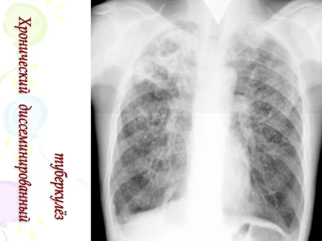 Хронический диссеминированный туберкулёз