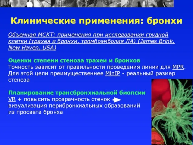 Объемная МСКТ: применения при исследовании грудной клетки (трахея и бронхи, тромбоэмболия ЛА)