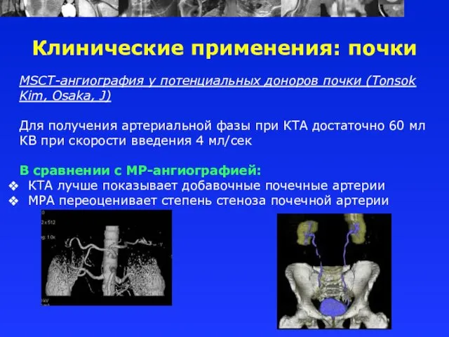 MSCT-ангиография у потенциальных доноров почки (Tonsok Kim, Osaka, J) Для получения артериальной