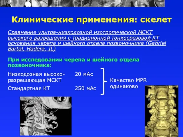 Сравнение ультра-низкодозной изотропической МСКТ высокого разрешения с традиционной тонкосрезовой КТ основания черепа