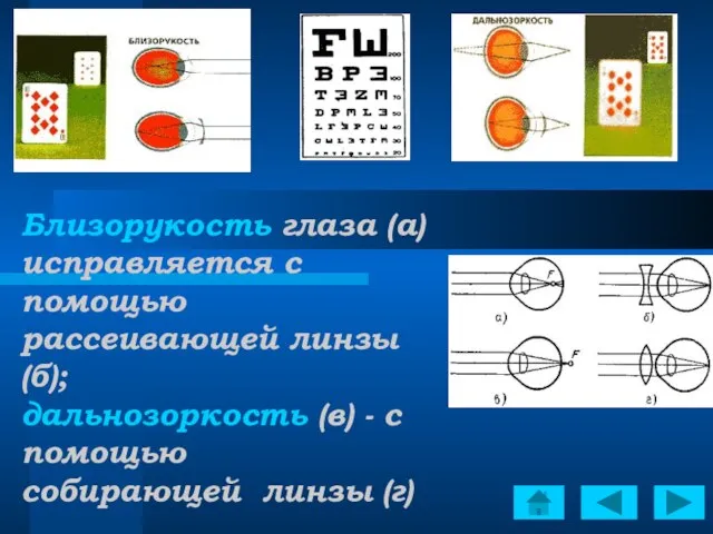 Близорукость глаза (а) исправляется с помощью рассеивающей линзы (б); дальнозоркость (в) -