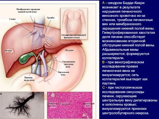 А - синдром Бадда-Киари возникает в результате нарушения печеночного венозного кровотока из-за