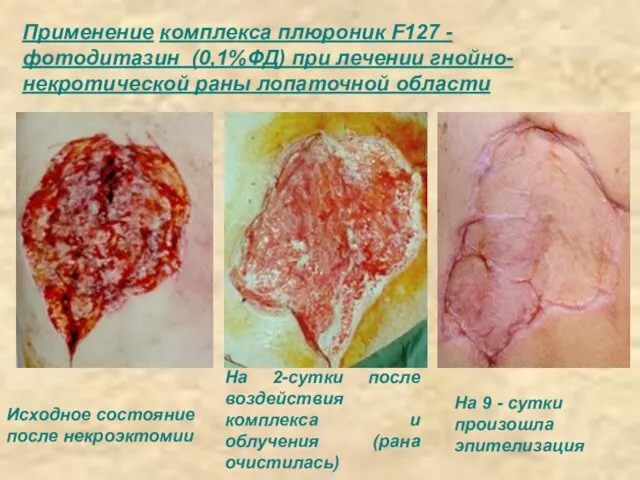 Применение комплекса плюроник F127 - фотодитазин (0,1%ФД) при лечении гнойно-некротической раны лопаточной