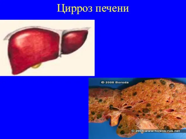 Цирроз печени