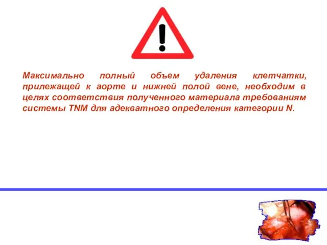 Максимально полный объем удаления клетчатки, прилежащей к аорте и нижней полой вене,