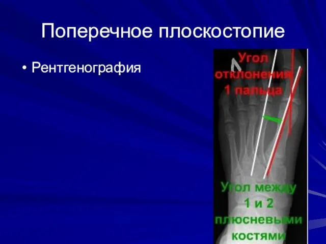 Поперечное плоскостопие Рентгенография