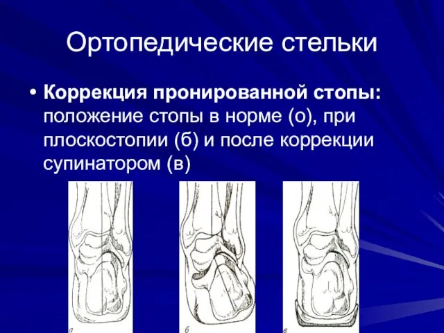 Ортопедические стельки Коррекция пронированной стопы: положение стопы в норме (о), при плоскостопии