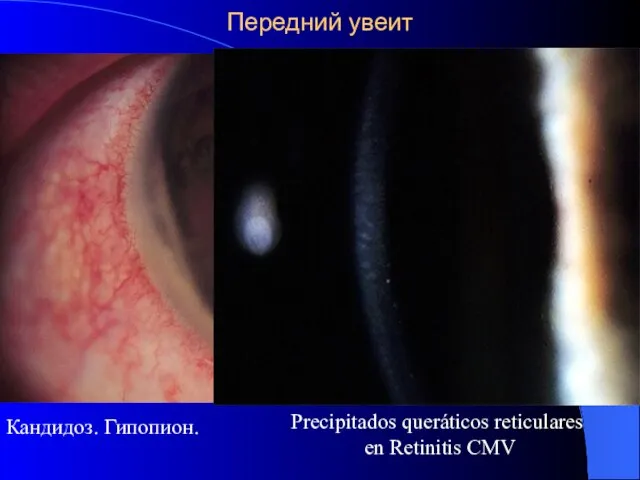 Передний увеит Кандидоз. Гипопион. Precipitados queráticos reticulares en Retinitis CMV