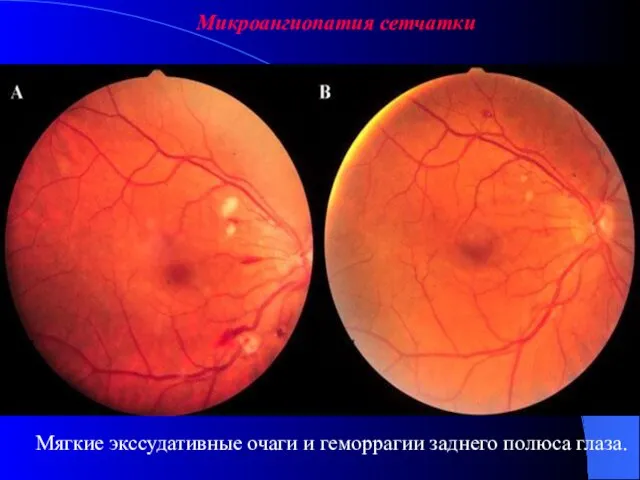 Микроангиопатия сетчатки Мягкие экссудативные очаги. Мягкие экссудативные очаги и геморрагии заднего полюса глаза.