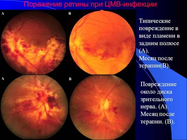 Поражение ретины при ЦМВ-инфекции Типические повреждение в виде пламени в задним полюсе
