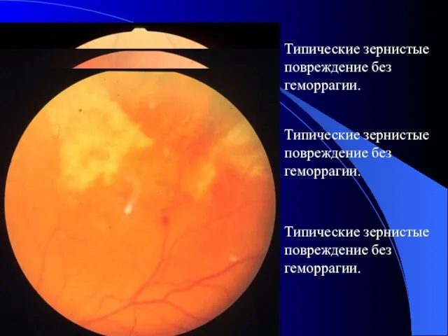 Типические зернистые повреждение без геморрагии. Типические зернистые повреждение без геморрагии. Типические зернистые повреждение без геморрагии.