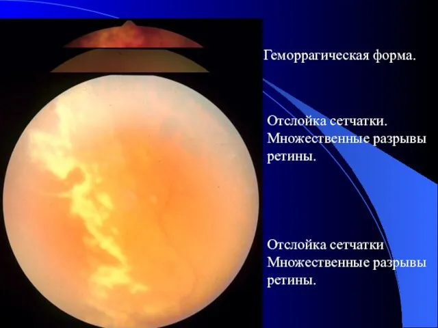 Геморрагическая форма. Отслойка сетчатки. Множественные разрывы ретины. Отслойка сетчатки Множественные разрывы ретины.