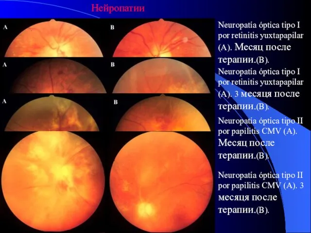 Нейропатии Neuropatía óptica tipo I por retinitis yuxtapapilar (A). Месяц после терапии.(B).