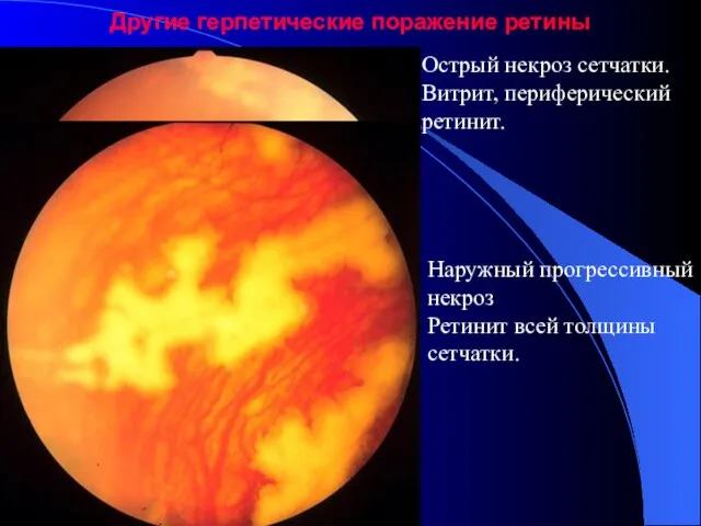 Другие герпетические поражение ретины Острый некроз сетчатки. Витрит, периферический ретинит. Наружный прогрессивный