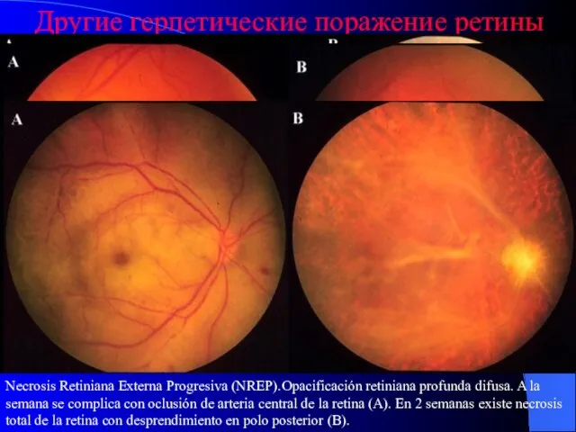Другие герпетические поражение ретины Острый прогрессивный некроз сетчатки.Глубокие повреждение сетчатки.(A). Месяц после