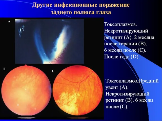 Другие инфекционные поражение заднего полюса глаза Токсоплазмоз. Некротизируюший ретинит (A). 2 месяца