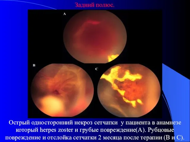 Задний полюс. Острый односторонний некроз сетчатки у пациента в анамнезе который herpes