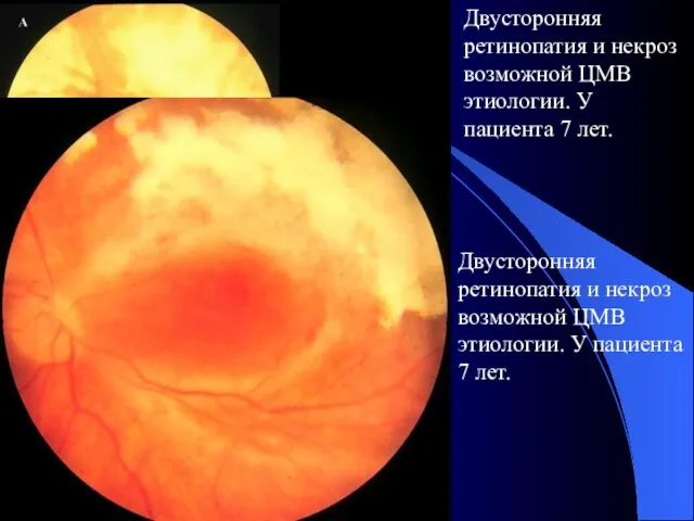 Двусторонняя ретинопатия и некроз возможной ЦМВ этиологии. У пациента 7 лет. Двусторонняя