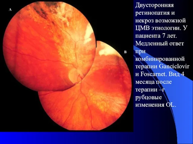 Двусторонняя ретинопатия и некроз возможной ЦМВ этиологии. У пациента 7 лет. Медленный