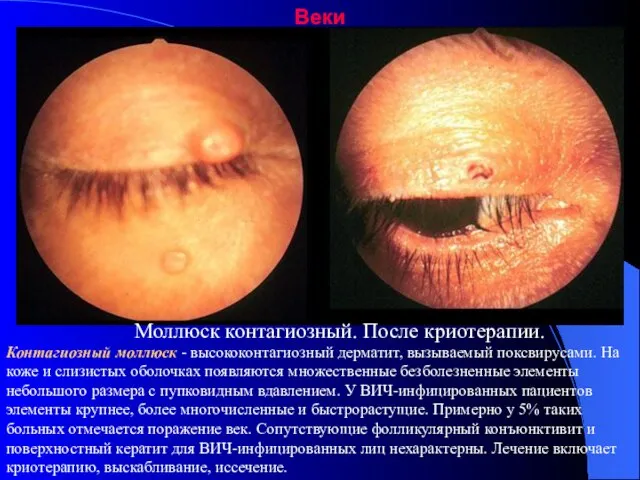 Веки Моллюск контагиозный. После криотерапии. Контагиозный моллюск - высококонтагиозный дерматит, вызываемый поксвирусами.