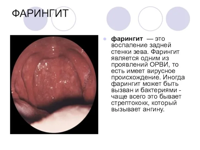 ФАРИНГИТ фарингит — это воспаление задней стенки зева. Фарингит является одним из