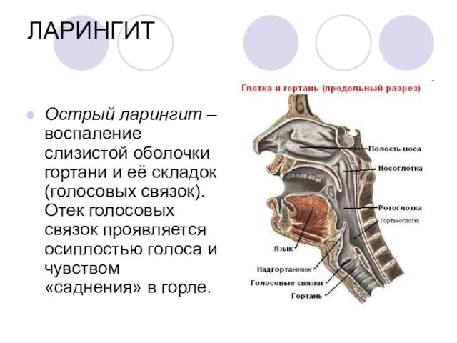 ЛАРИНГИТ Острый ларингит – воспаление слизистой оболочки гортани и её складок (голосовых