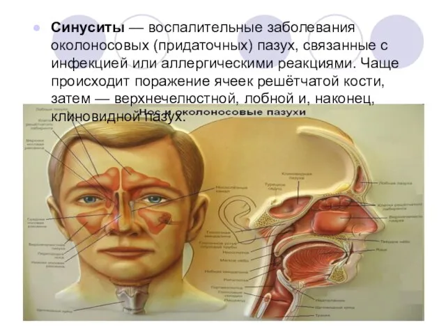 Cинуситы — воспалительные заболевания околоносовых (придаточных) пазух, связанные с инфекцией или аллергическими