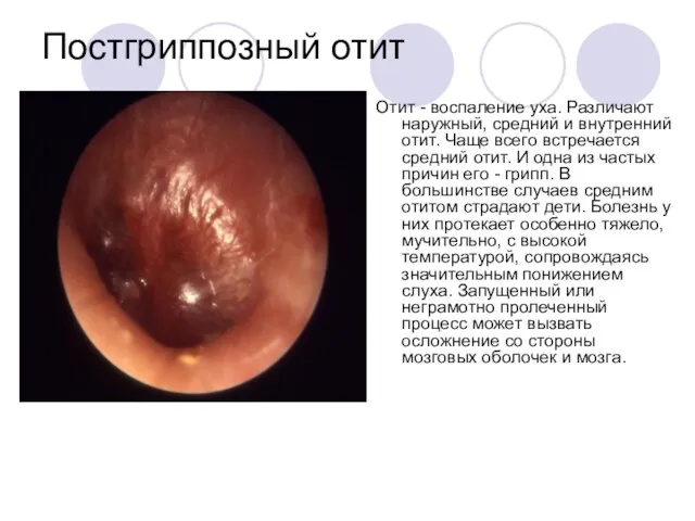 Постгриппозный отит Отит - воспаление уха. Различают наружный, средний и внутренний отит.