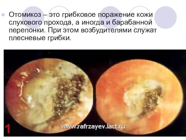 Отомикоз – это грибковое поражение кожи слухового прохода, а иногда и барабанной