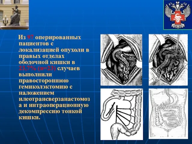 Из 97 оперированных пациентов с локализацией опухоли в правых отделах ободочной кишки