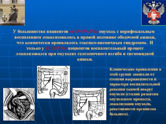 У большинства пациентов (n=39 (76,5%) опухоль с перифокальным воспалением локализовалась в правой