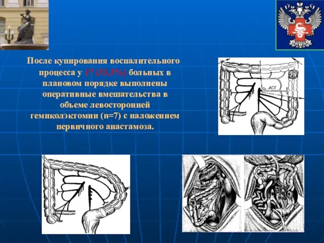 После купирования воспалительного процесса у 17 (33,3%) больных в плановом порядке выполнены