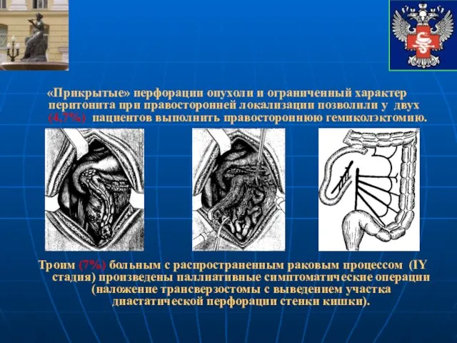 «Прикрытые» перфорации опухоли и ограниченный характер перитонита при правосторонней локализации позволили у