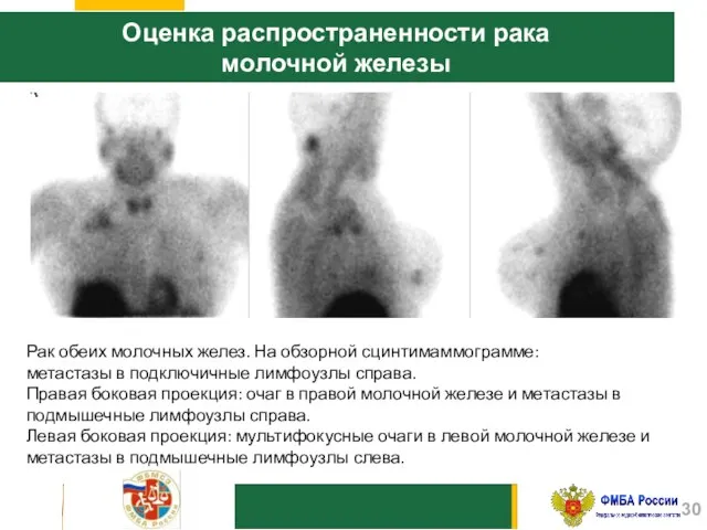 Оценка распространенности рака молочной железы Рак обеих молочных желез. На обзорной сцинтимаммограмме: