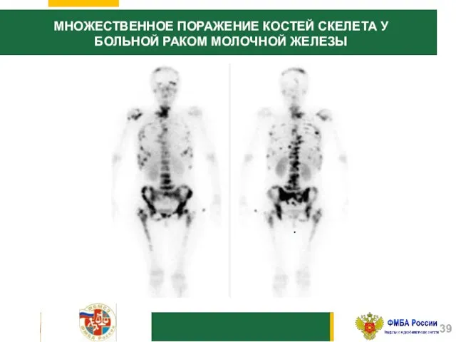 . МНОЖЕСТВЕННОЕ ПОРАЖЕНИЕ КОСТЕЙ СКЕЛЕТА У БОЛЬНОЙ РАКОМ МОЛОЧНОЙ ЖЕЛЕЗЫ