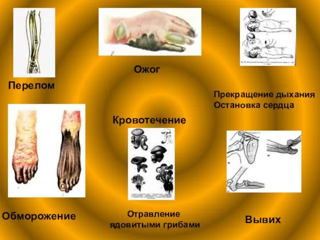 Перелом Ожог Прекращение дыхания Остановка сердца Обморожение Отравление ядовитыми грибами Вывих Кровотечение