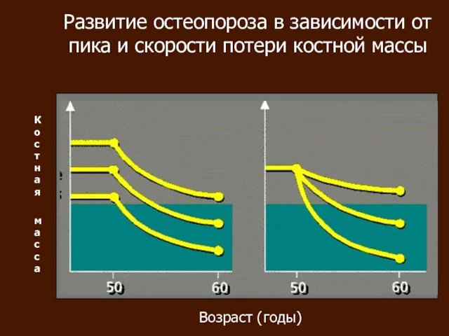 Развитие остеопороза в зависимости от пика и скорости потери костной массы Возраст (годы) Костная масса