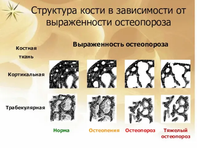 Структура кости в зависимости от выраженности остеопороза Кортикальная Трабекулярная Костная ткань Выраженность